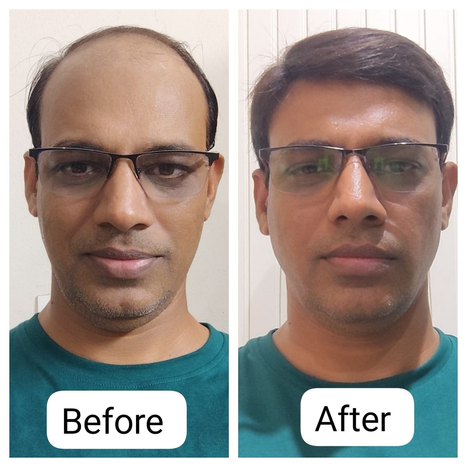 Non-surgical hair replacement consultation in Chennai